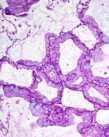 ADENOCARCINOMA CLASSIFICATION PREINVASIVE LESIONS AAH ADC-in-situ (formerly pure BAC)