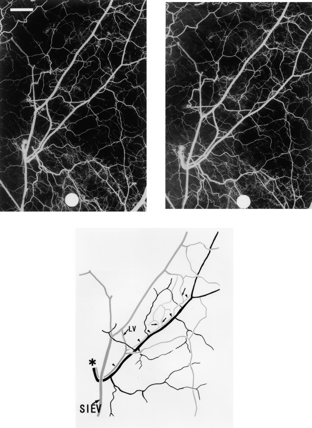 Anatomical relationship between arteries and veins in the paraumbilical region 555 Fig. 3 (Above) Stereographic angiograms of a large paraumbilical arterial and venous perforators.
