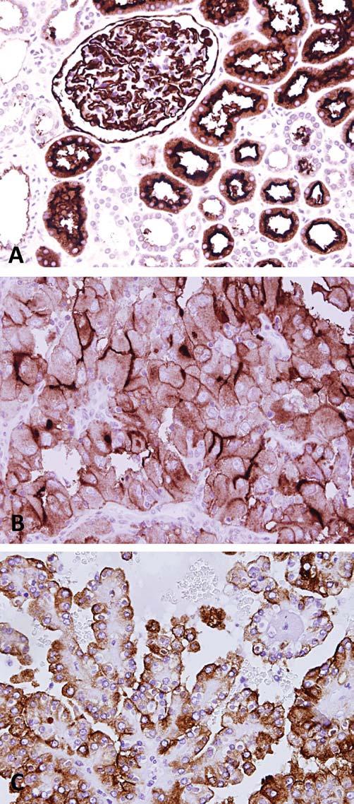 Figure 4. CD10: A, Normal kidney Strong staining was shown in proximal, tubular cell brush border and cytoplasm, with accentuation for the former.