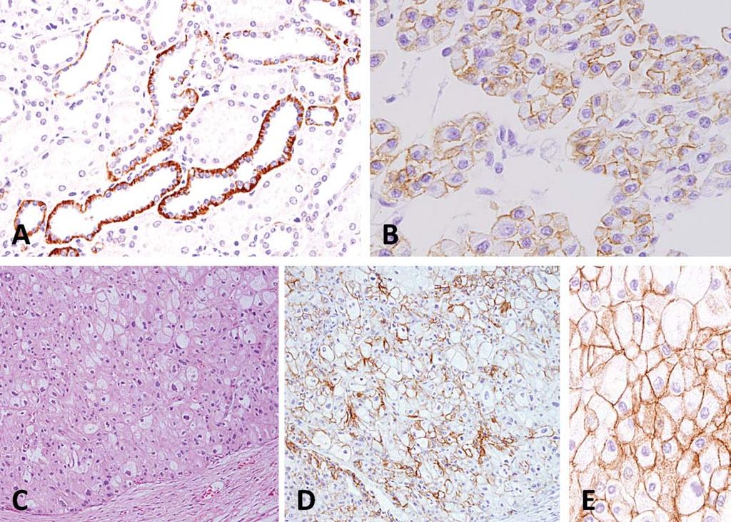 Figure 5. Kidney-specific cadherin: A, Normal kidney Staining is limited to the basolateral portion of the distal renal tubular cells. B, Oncocytoma Diffuse membranous staining.
