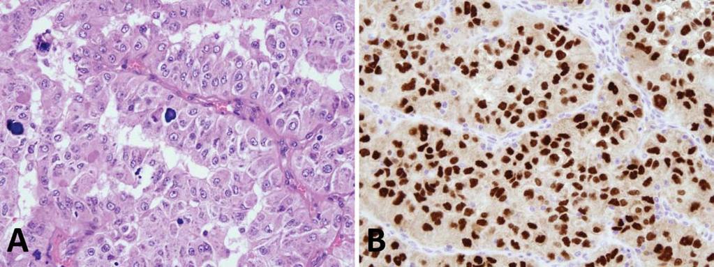 Oncocytoma Oncocytomas are the most-common benign renal neoplasm. Numerous studies 16,17,23 29 have attempted to identify markers that can reliably differentiate oncocytoma from chromophobe RCC.