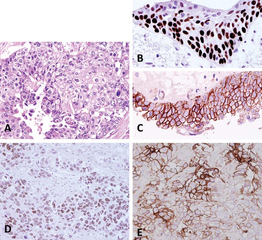 Figure 7. p63 and thrombomodulin: A, High-grade urothelial carcinoma displaying features that overlap with collecting duct or high-grade clear cell renal cell carcinoma (RCC).