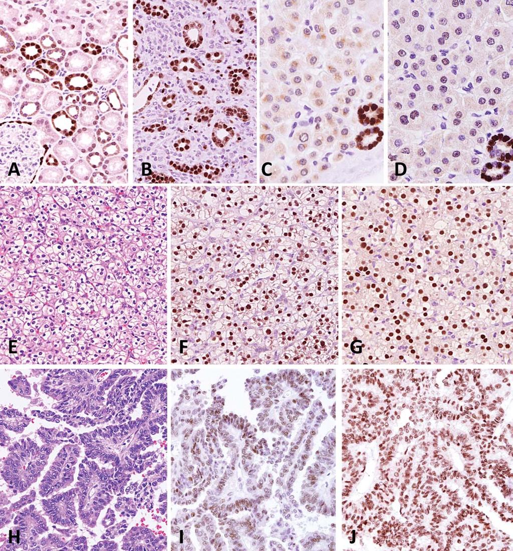 Figure 1. PAX2 and PAX8: Their staining patterns are very similar. A, Normal kidney: PAX2 staining in distal tubular cells and glomerular visceral epithelial cells.