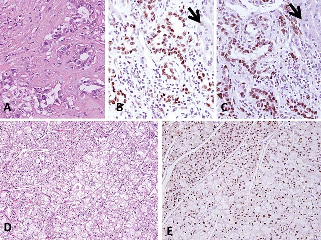 Figure 2. A, B, and C, PAX2 and PAX8: Collecting duct renal cell carcinoma (RCC) Strong, nuclear staining for both PAX2 (A and B) and PAX8 (C).