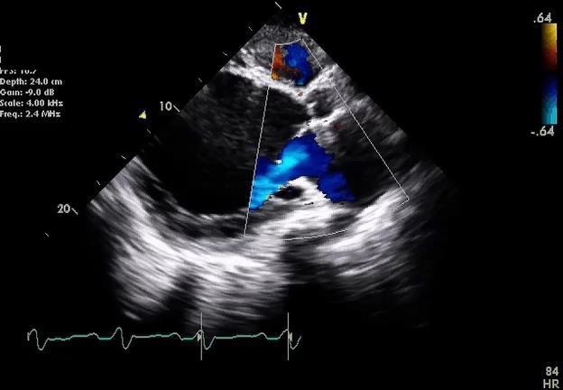 Echo #1: Prior to LVAD Implantation Severely dilated and hypokinetic LV Marked