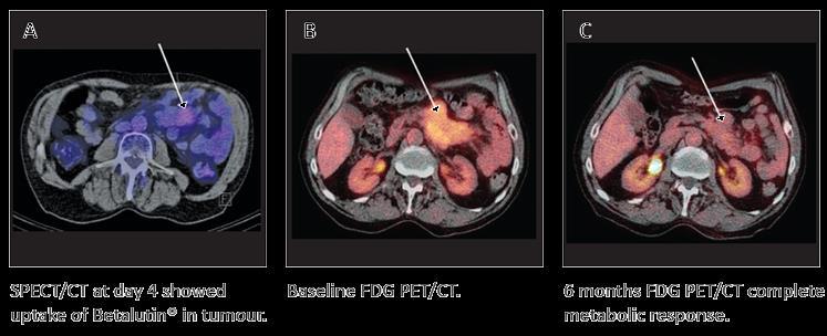 Complete metabolic response (FDG PET/CT) at 6 months in patient
