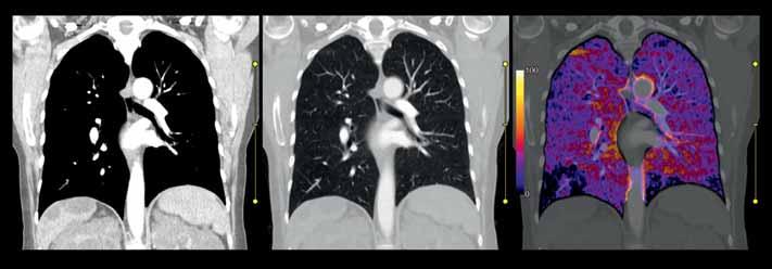Lung Subtraction 1 A 51-year-old female was scanned with the Subtraction Lung protocol to follow up on nown pulmonary
