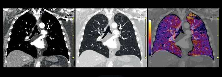 Lung Subtraction 2 This 72-year-old male presented with a suspicion for pulmonary embolisms.