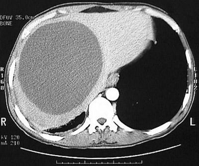 Hepatic Cyst Aial C+ CT Film Findings: Sharply demarcated, non enhancing,