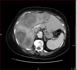 Liver Metastasis (Colonic Adenocarcinoma) Aial C+ CT Film Findings: Multiple