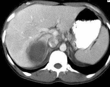 Liver Abscess Aial C+ CT Film Findings: Well demaracated hypoenhancing lesion Rim of increased