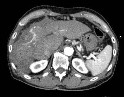 PS: Post-RFA Images Aial CT C+ Immediately after RFA