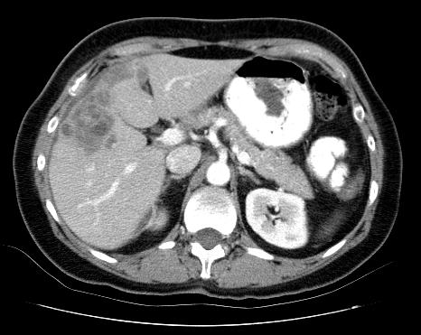 Admission CT with contrast Cystic lesion of the liver with multiple