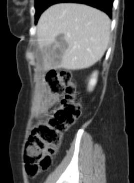 Our patient: Radiographic Findings Cystic liver lesion with multiple tubular septation Diverticulosis Contiguous inflammation surrounding the