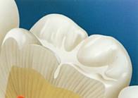 Why Choose Sealants Virtually prevents all pit and fissure caries About 80 % of caries occurs in pits and fissures Nature