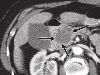 pseudocyst. Fig. 3 CT of serous cystadenoma.