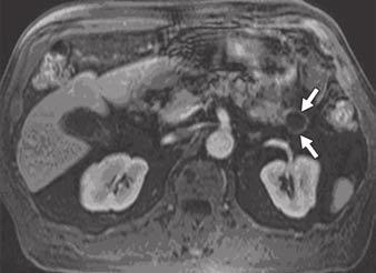 pancreas with classic appearance of lobulated outline, fine internal septation, lack of vascular encasement, and central