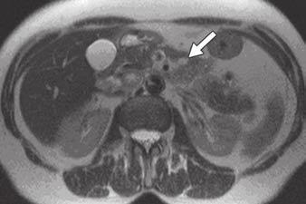 On CT and MRI, the diagnosis of cystic neuroendocrine tumor may be suggested by a rim of highly vascularized tissue that shows avid enhancement in the early arterial phase, a feature that correlates