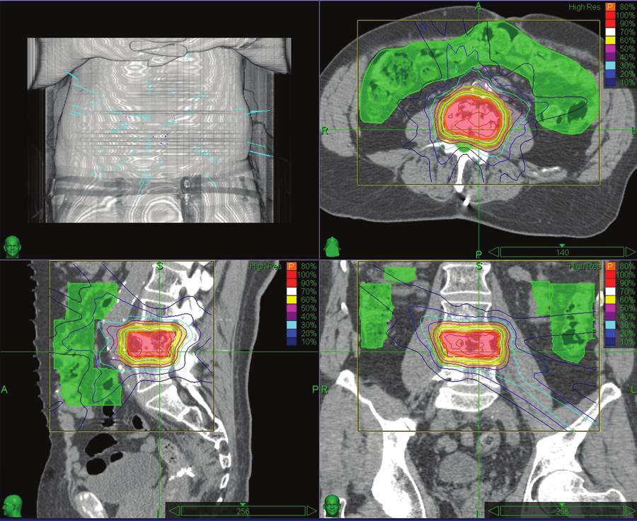 D. E. Heron et al. rological deficits. External-beam radiation therapy has long been considered the appropriate first-line treatment for metastatic tumors of the spine.