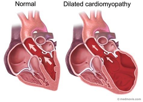 DILATED CARDIOMYOPATHY Dilated or congestive cardiomyopathy (DCM) is diagnosed when the heart is enlarged (dilated) and the pumping chambers contract poorly (usually left side worse than right).