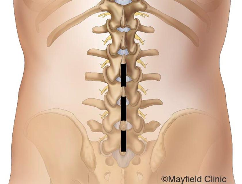 3 The surgical decision Decompression surgery for spinal stenosis is elective, except in the rare instance of cauda equina syndrome or rapidly progressing neurologic deficits.