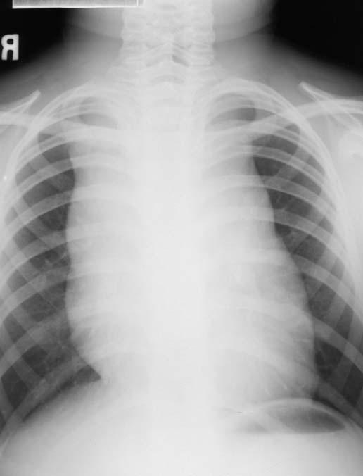 9 Thymoma in a 10-year-old boy Grossly widened mediastinum