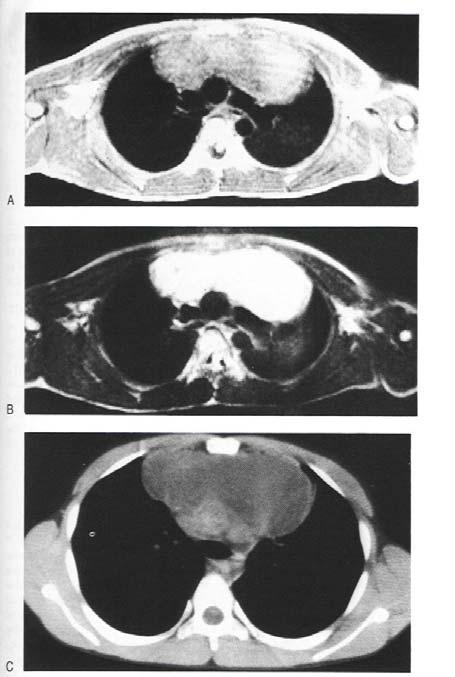 12 Thymic Cyst: Looking for fluid Anterior Mass is indeterminate on T1 3% of anterior mediastinal masses Mass is hyperintense on T2 Mass on