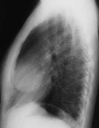 anterior mediastinum From BIDMC teaching files May contain calcifications visible on