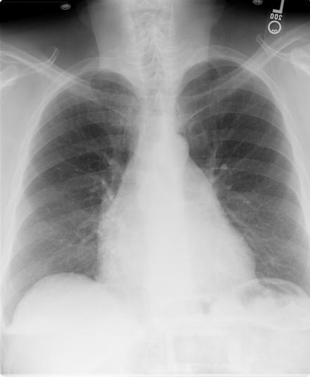 18 The Chest X-ray Largely unremarkable BUT, contour of right heart border is unusual Hilar vessels
