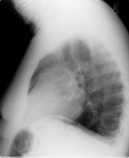 19 The Chest X-ray: Lateral Confirms anterior location