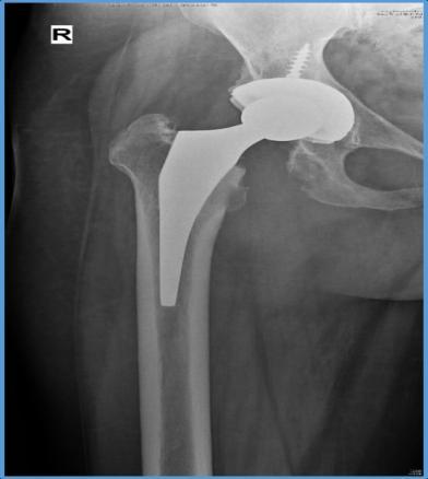 Figure 1-1.5 year follow-up of right total hip arthroplasty. Local examination of thigh did not show any contributory sign. With conservative treatment she did not get relief.