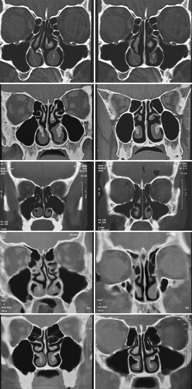 Fig. 4 Preoperative (left) and postoperative (right) CT images of nasal septum and turbinate in five different patients.