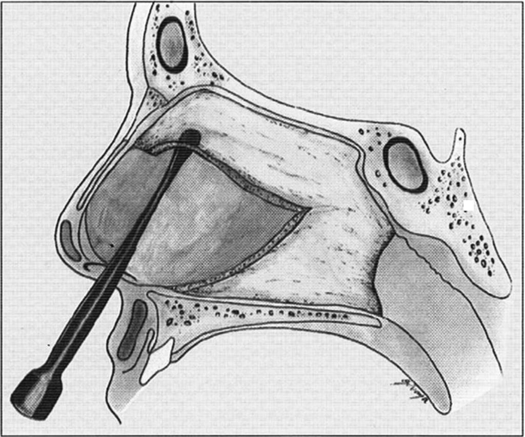 284 A Comparative Study between Universal Eclectic Septoplasty and Cottle Amaral Neto et al.