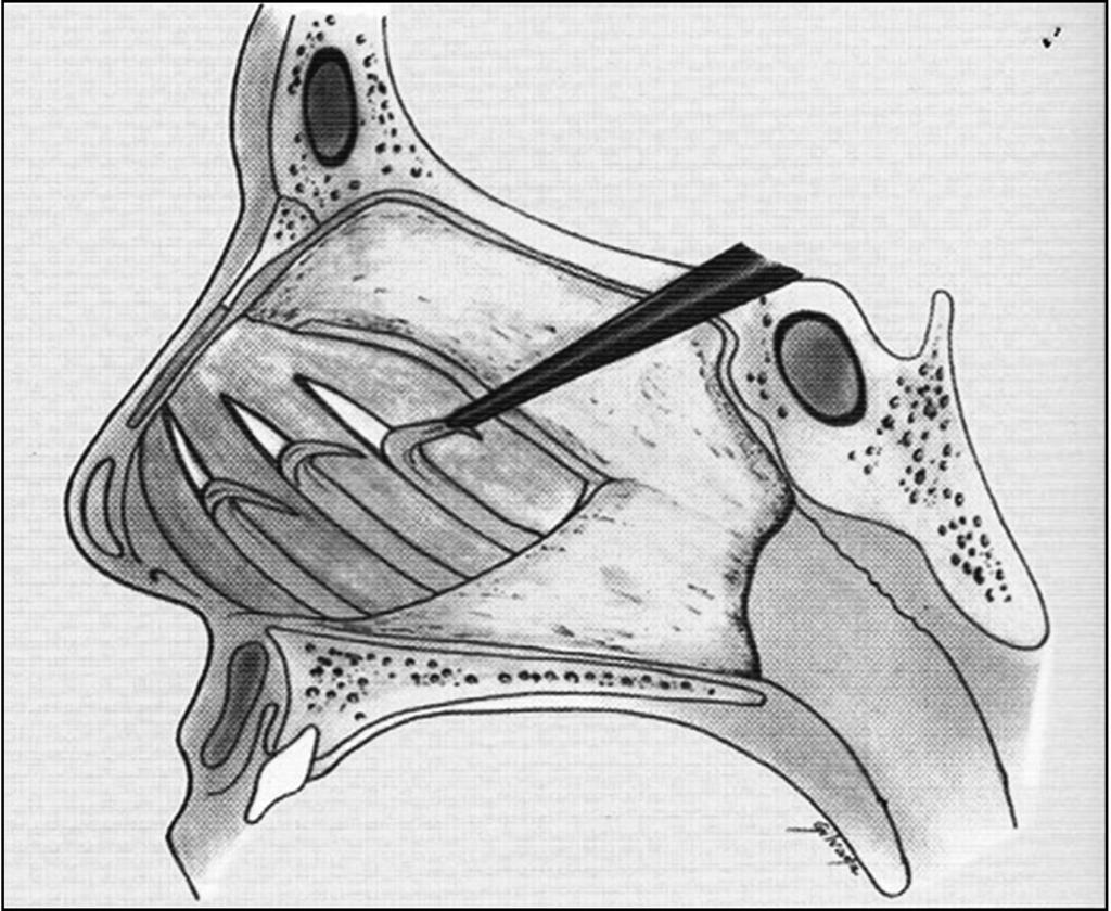 effective. The safer surgical technique consists of the dissection of the concave side of the perichondrium, preserving its convex side connected to the cartilage ( Fig. 1).