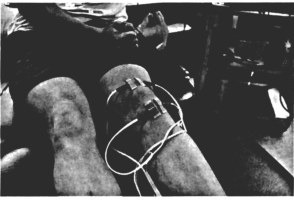 FIGURE 2. Set-up for high-intensity electrical stimulation. exercises. Medial patella mobility was treated using passive medial gliding of the patella to stretch the lateral soft tissue structures.
