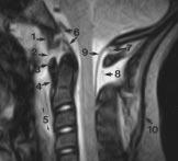 0-T MR scanner shows isolated tear of left alar ligament (1) and deviation of dens (2) toward right with respect to lateral masses of C2 (3). Transverse ligament (4) is intact.