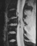 MR Imaging of Spinal Injury Fig. 7. urst fracture of C7 in 30-year-old woman who was unrestrained driver in motor vehicle crash.