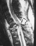 5-T MR scanner shows burst fracture of C7 (1), prevertebral edema or hemorrhage (2), flaval (3) and interspinous ligament tears (4), with associated distraction of dorsal spines and spinal cord
