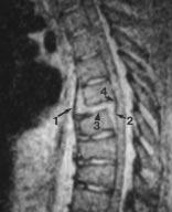 MR Imaging of Spinal Injury Fig. 15. Ligament stripping in 450-lb (202.5-kg) 35- year-old man ejected from motor vehicle. Lateral radiographs (not shown) were nondiagnostic.
