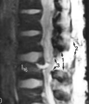 3-T MR scanner shows anterior longitudinal ligament stripped completely away from anterior surface of midthoracic spine vertebral body (1).
