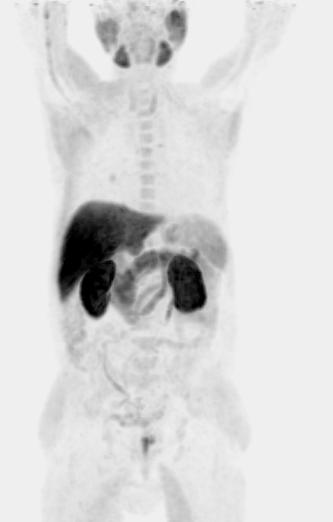 PET+CT CT alone Diagnostic accuracy 87 % 59 % Stadium (N2/N3) PET+CT Only CT