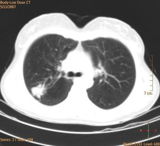 -staging CT SPECT