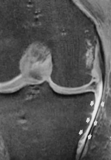 reveals MCL bursa (arrows)., Axial MR image also shows MCL bursa (arrows). C, Corresponding coronal anatomic slice reveals MCL bursa (arrows) deep in relation to superficial portion of MCL.