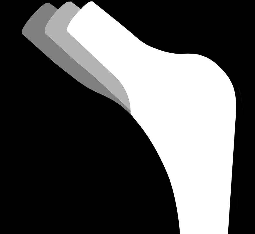 The lateral shoulder of the Absolut Stem has been de-bulked, decreasing the risk of greater trochanteric fracture during rasping.