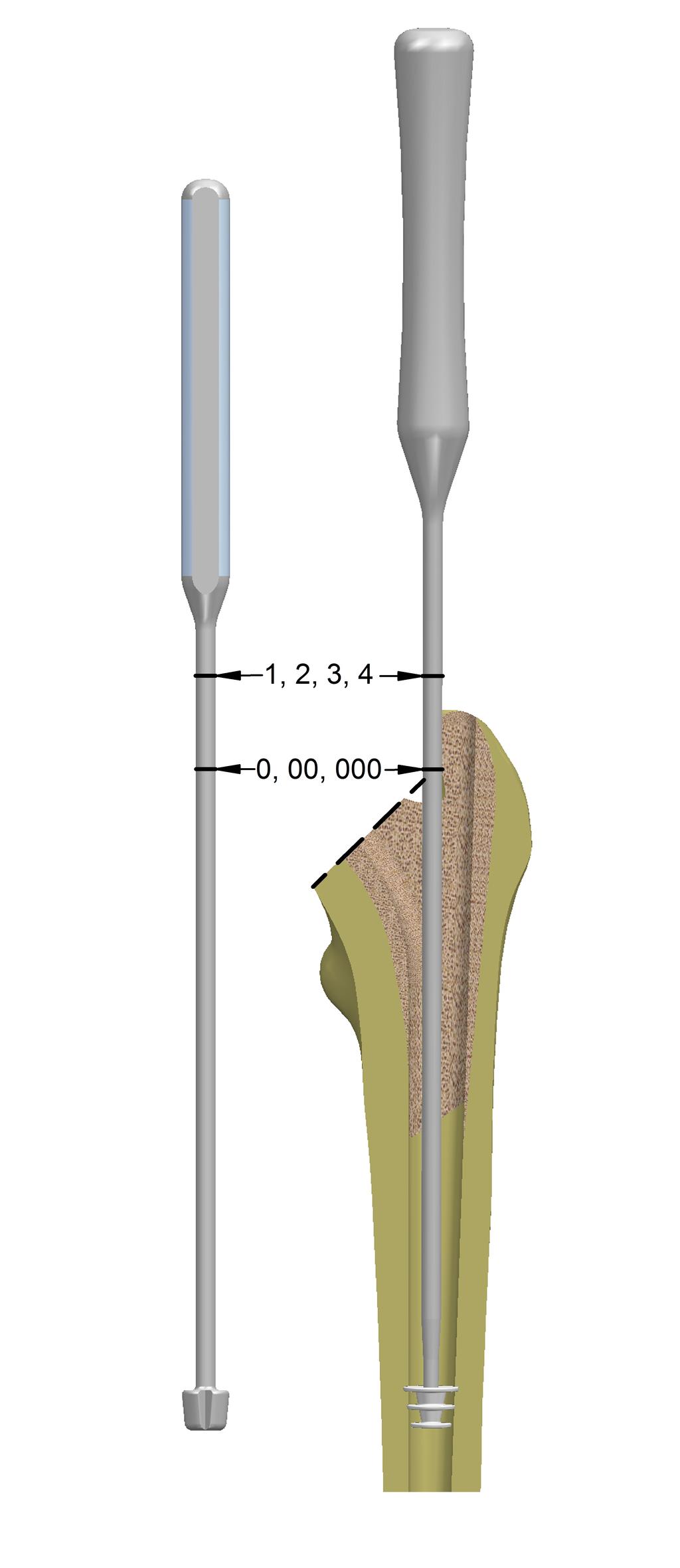 Sizes 000, 00 and 0 offer a decreased selection of neck offsets to maintain implant strength.