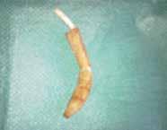Image 2: The tip of the catheter after the removal during the second cystoscopy. A calcium oxalate stone had been formed around the catheter preventing the neurosurgeon to pull it otherwise.