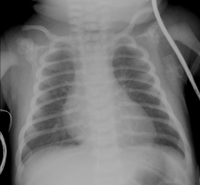 TGA on Plain Film Companion Patient #3: Normal pulmonary markings 1. Mild cardiomegaly Portable AP Plain Film, 2 day old patient 2.
