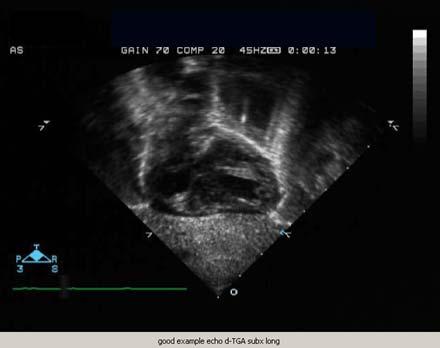 Companion Patient #5: Echo of TGA (Video) Posterior great artery arises from LV and divides into right and