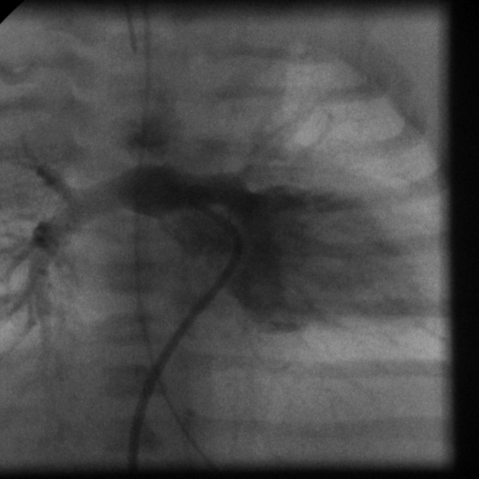 Companion Patient #6: Cineangiogram of TGA, AP View Pulmonary arteriogram AP View PA Finding: