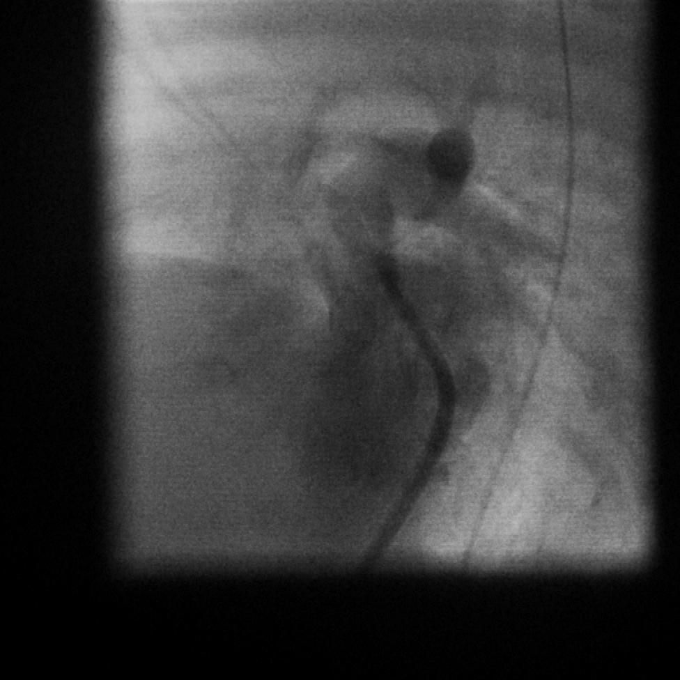 Companion Patient #6: Cineangiogram of TGA, Lateral View Left ventriculogram Lateral-Oblique View Ao PA